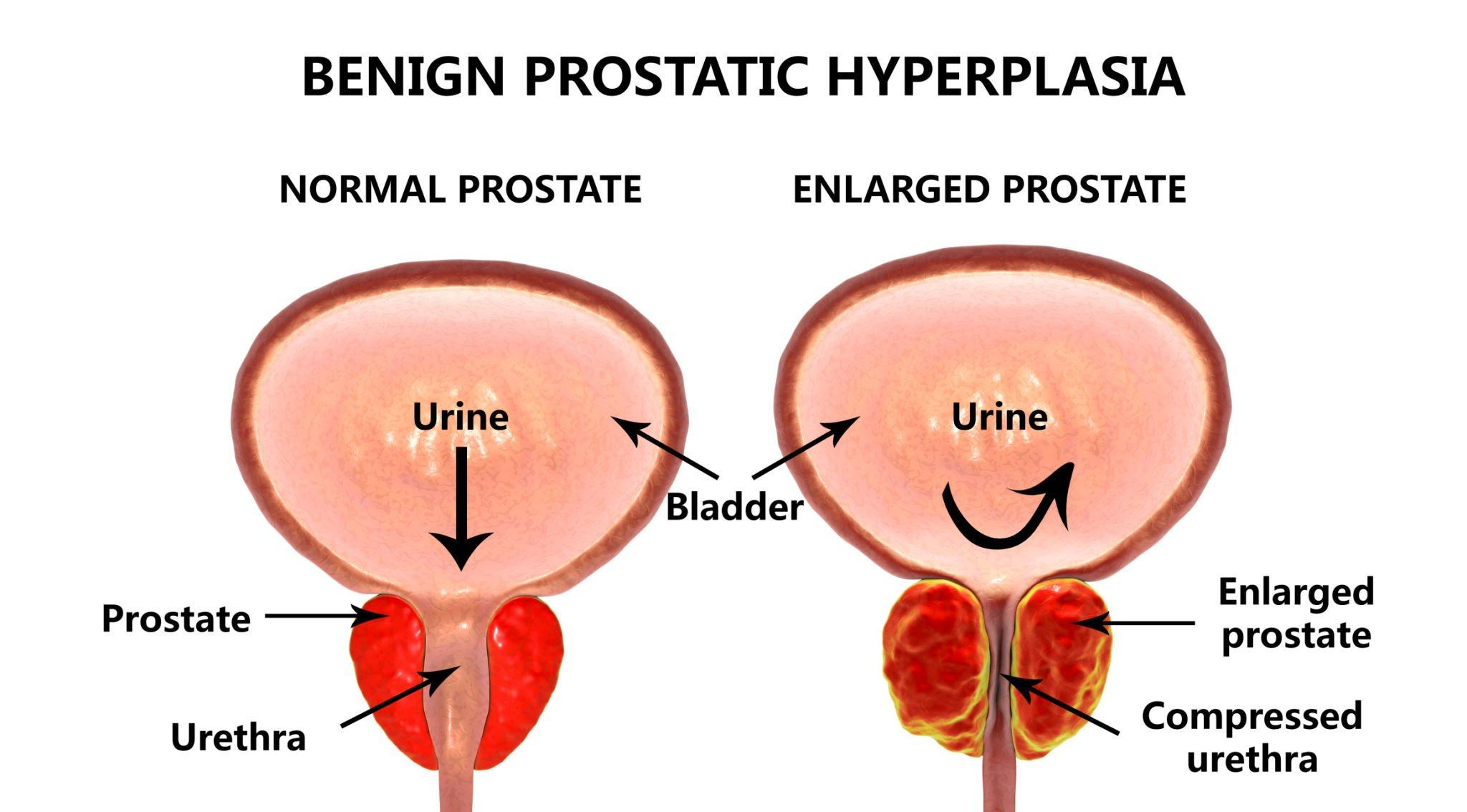 Does Enlarged Prostate Cause Bowel Problems Understanding an Enlarged Prostate: Symptoms, Causes, and Treatment