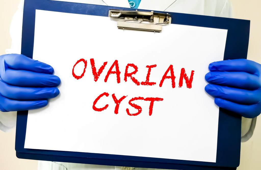 Ovarian Cyst 2