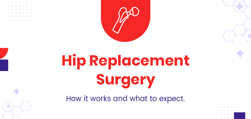 Hip Replacement Surgery: How It works And What To Expect