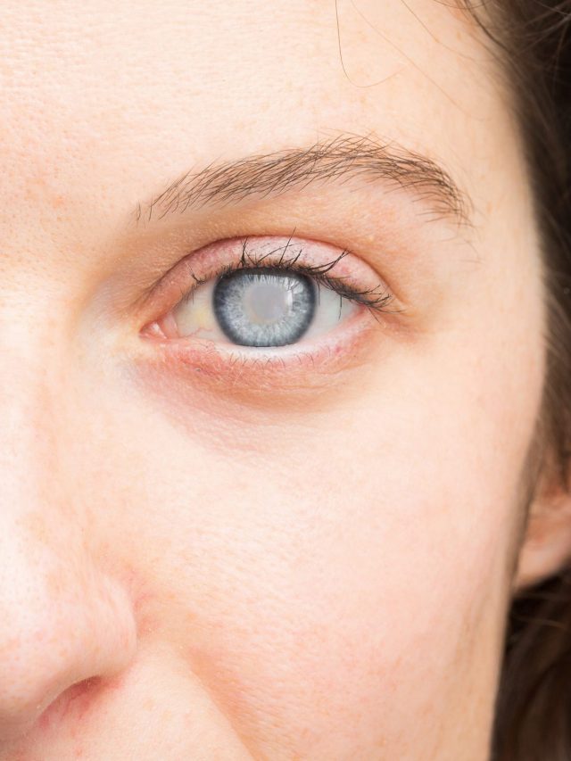 कैटरेक्ट क्या है (Cataract in hindi)