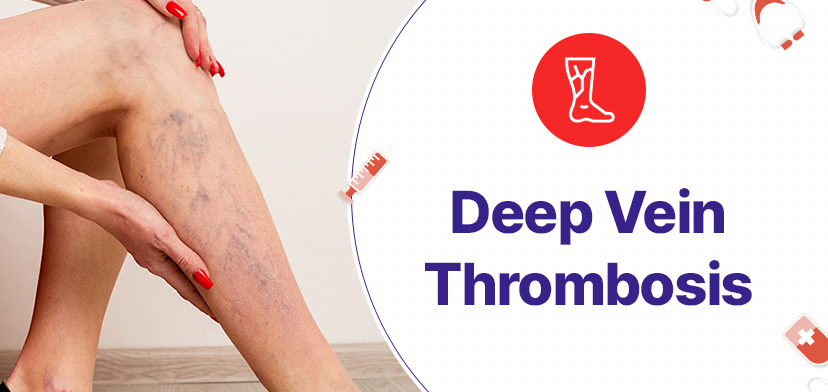 Treatment Options For Deep Vein Thrombosis: Medications, Surgery, And More  