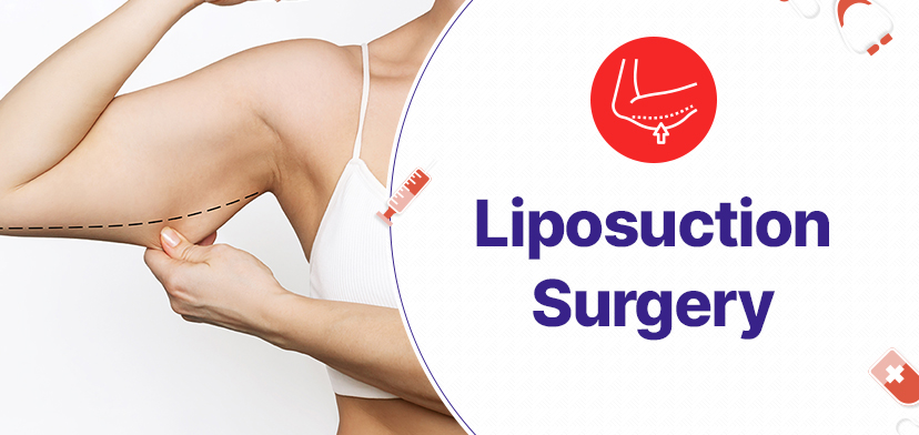 Liposuction Surgery in New Delhi