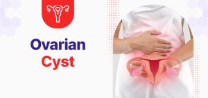 Ovarian Cyst treatment in Gurgaon