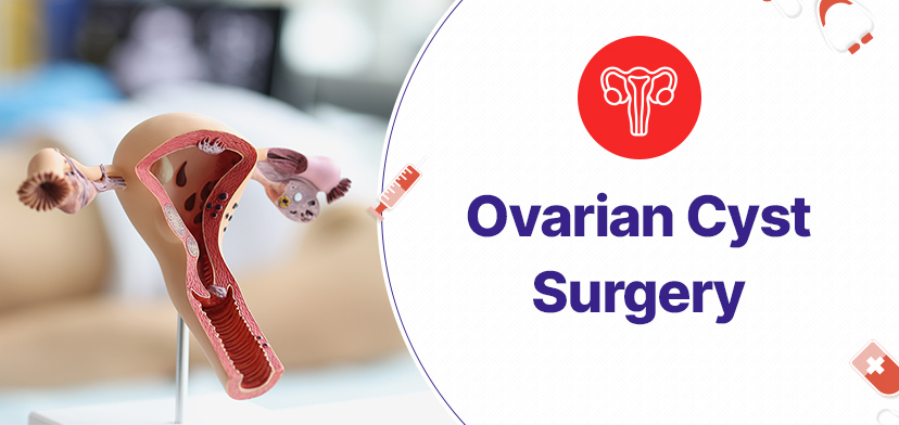 Ovarian Cyst Surgery
