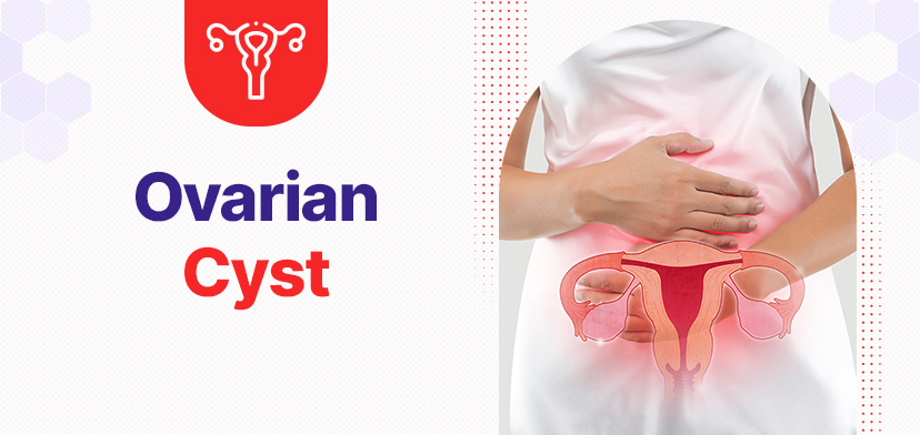 Ovarian Cyst: Diagnoses, Costs And Treatment In Gurgaon