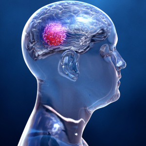 symptoms of Brain Tumor