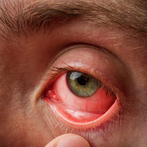 eye-conjunctivitis