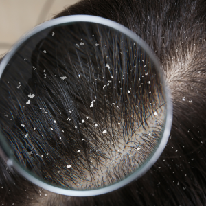 how to remove dandruff