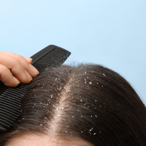 what is the reason of dandruff
