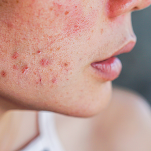home remedies for acne
