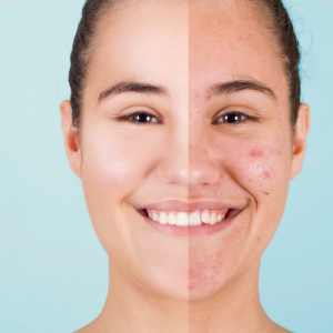home remedies for acne