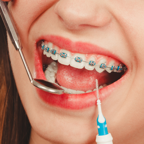 braces meaning in hindi
