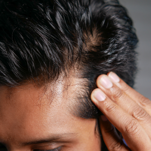 alopecia areata treatment in hindi