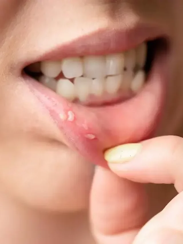 मुँह के कैंसर के लक्षण क्या है ?