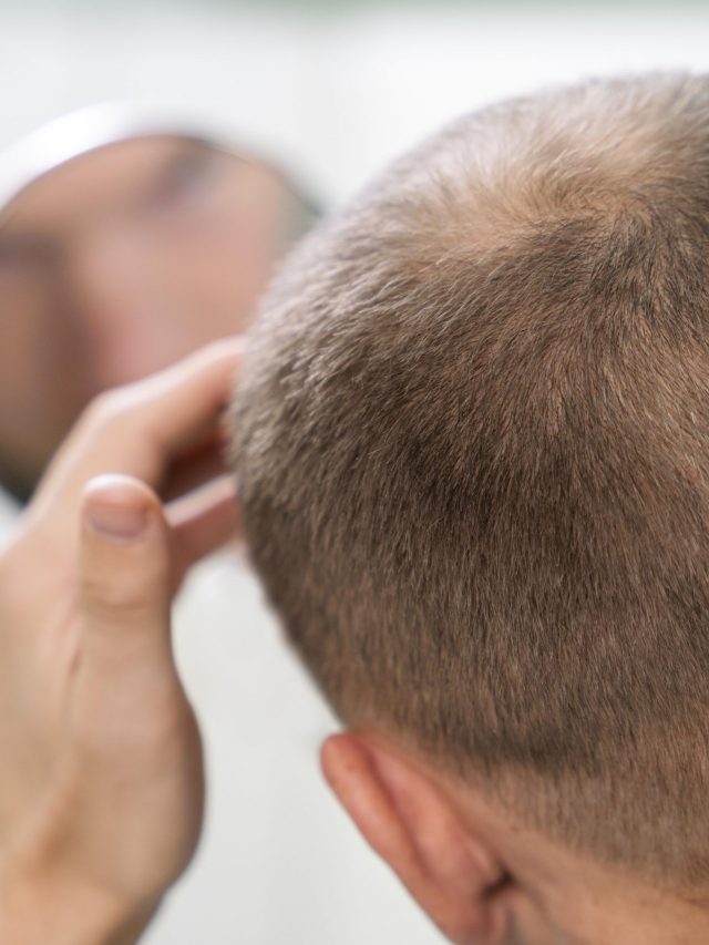 मिनोक्सिडिल के दुष्प्रभाव क्या हैं?